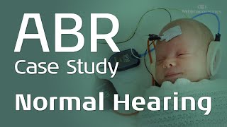 ABR Case Study Normal Hearing [upl. by Erreid899]