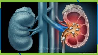 Patologias Sistema Urinário [upl. by Bibbye]