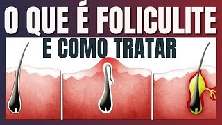 O que é Foliculite e como tratar [upl. by Qiratla662]