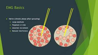 Hyperthyroidism  an Osmosis Preview [upl. by Eelahc702]