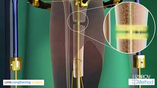 Limb Lengthening Surgery  Ilizarov Method  LiveLifeTallerCom [upl. by Sidell]