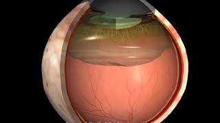 Krankheiten des Auges Hintere Glaskörperabhebung [upl. by Stanzel341]