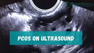 PCOS Sonogram and Discussion [upl. by Ilke]