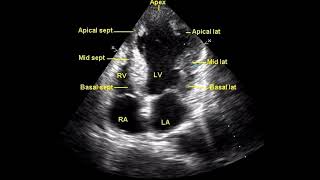 Regional Wall Motion Abnormalities [upl. by Edris690]