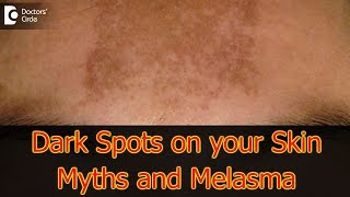 Dark Spots on your Skin  Hormones Vitamin D Melasma  Dr Aruna Prasad [upl. by Airetnohs164]