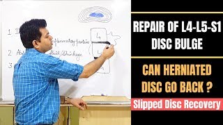 Repair Of Disc Bulge Can Herniated Disc Heal Lumbar Disc Herniation Recovery Slipped Disc Heal [upl. by Billy558]