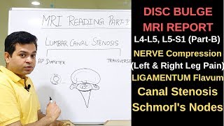 Herniated disc MRI How to read MRI lumbar spine Nerve compression L4L5 L5S1 Canal Stenosis [upl. by Head830]