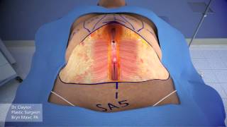 Dr Claytor Demonstrates Drainless Tummy Tuck with Liposuction  3D Animation [upl. by Larentia]