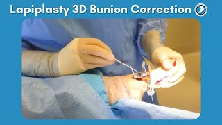 Lapiplasty Procedure  3D Bunion Correction with Dr Paul Steinke [upl. by Lleryd]