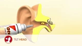 How to use Otex Ear Drops [upl. by Eenwahs]