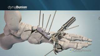 DynaBunion™ 4D MinimalIncision Lapidus System  Narrated Animation [upl. by Volotta74]