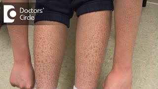 How to manage Ichthyosis Vulgaris in teenage boys  Dr Nischal K [upl. by Mcripley]