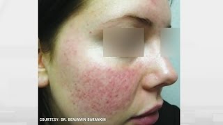 Rosacea relief How to treat persistent facial flushing [upl. by Ditzel421]