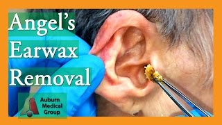 Water Device Painlessly Removes Earwax  Art Insider [upl. by Aynod]