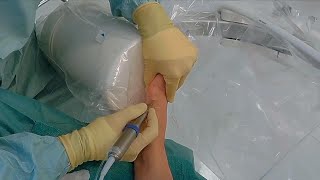 New Less Invasive Bunion Surgery [upl. by Resor]