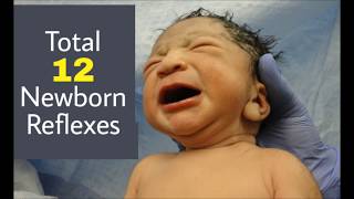 Newborn Reflexes I Neonatal Reflexes [upl. by Feldt]