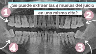 ¿SE PUEDEN EXTRAER LAS 4 MUELAS DEL JUICIO EN UNA MISMA CITA [upl. by Neiviv]