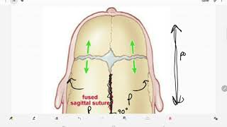 Craniosynostosis [upl. by Galliett241]