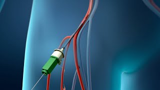 Breakthroughs in vascular surgery [upl. by Drofdeb]