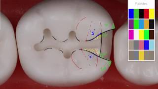 Class II Amalgam 19 MO Acadental  Amalgam Preparation Technique [upl. by Ennaeus]