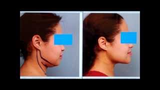 Sculpt the Chin amp Neck With Liposuction  Dr Sterry Explains [upl. by Wiskind]