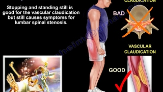 Lumbar Spinal Stenosis  Everything You Need To Know  Dr Nabil Ebraheim [upl. by Cleres]