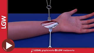 Wrist Fixator Surgery 3D Animation [upl. by Yrrat94]