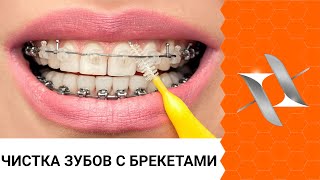 Полный алгоритм чистки зубов с брекетами 6 шагов [upl. by Freedman]