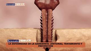 La enfermedad de la garrapata Síntomas tratamiento y prevención [upl. by Carolyne]