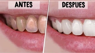 ¡DIENTES BLANCOS EN 2 MINUTOS REMEDIOS CASEROS Y NATURALES PARA BLANQUEAR LOS DIENTES  Vania [upl. by Wanfried838]