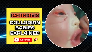 Ichthyosis Collodians Tale  Complete Guide [upl. by Eehc]