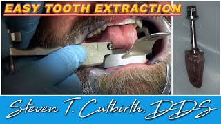 Easy Tooth Extraction  Dental Minute with Steven T Cutbirth DDS [upl. by Ebaj]