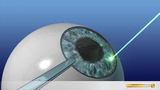 AugenOP mit Laser So funktioniert LASIK [upl. by Porta]