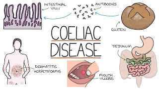 Celiac Disease and Gluten [upl. by Ondrea]