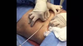 Tumescent Liposuction for Fat Removal [upl. by Efthim]