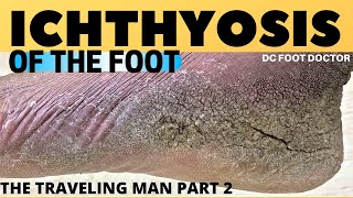 Ichthyosis of the Foot Travelin Mans Severe Skin Condition and Treatment [upl. by Starla770]