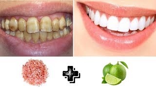 COMO BLANQUEAR LOS DIENTES EN 2 MINUTOS REMEDIO CASERO [upl. by Standice]