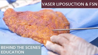 The Science Behind Vaser Liposuction How Does It Work [upl. by Farkas576]