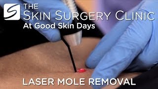 Laser Mole Removal  Watch the Procedure [upl. by Annoel]