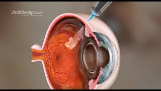 Intravitreal Injection Animation HD [upl. by Eyanaj804]