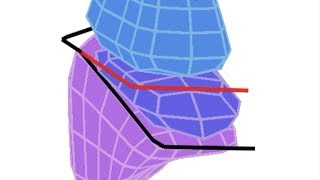 Thoracic Imaging Pulmonary Nodule – David Naeger MD [upl. by Acissev]