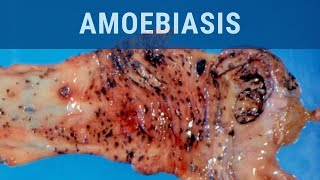 Amoebiasis  Pathology mini tutorial [upl. by Ostler]