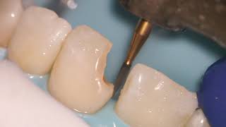 Teeth Bonding  Front tooth filling EXPLAINED [upl. by Lukash82]