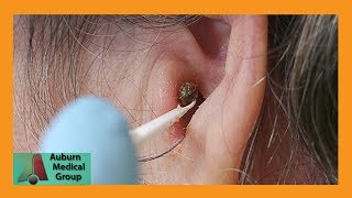 Chunky Earwax Removal  Auburn Medical Group [upl. by Cornwall812]