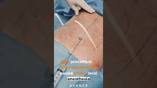 Liposuction procedure [upl. by Nyladnewg37]