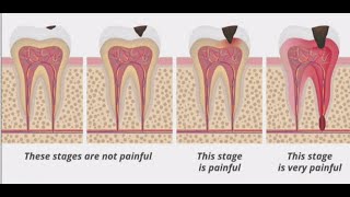 Stages of Tooth Decay Introduction [upl. by Oiziruam917]