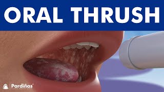 ORAL THRUSH  Candidiasis or yeast infection Angular cheilitis © [upl. by Efthim]