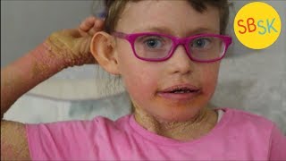 Living With Scaly Skin Ichthyosis [upl. by Ymmas]