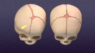 Plagiocephaly and Craniosynostosis [upl. by Tracie669]