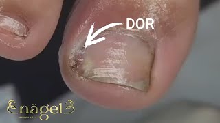 😮 A UNHA DELE SOLTOU DE TANTO PUS satisfying nails [upl. by Rame]